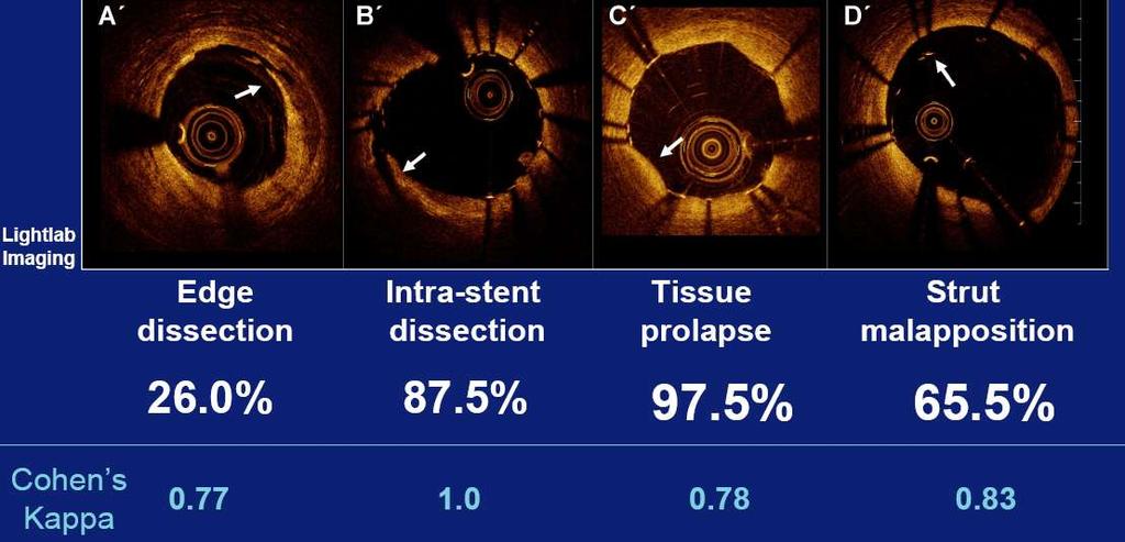 Optical coherence tomography assessment of the acute effects of stent implantation on the