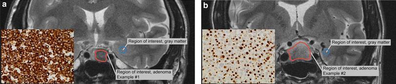 Tumor MRI and Histologic Phenotypes and Outcomes Cytokeratin Staining: Densely Granulated Sparsely Granulated MRI T2 Imaging: Lower T2 Intensity Higher T2 Intensity Densely Granulated tumors (lower