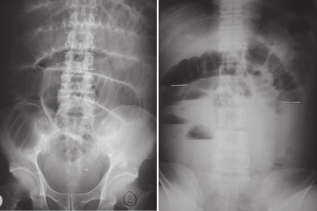 THAI J 42 Imaging of the Small Bowel GASTROENTEROL 2015 X-ray Corner Imaging of the Small Bowel Pantongrag-Brown L Small bowel is the longest tubular organ in the body, about 18-22 feet.
