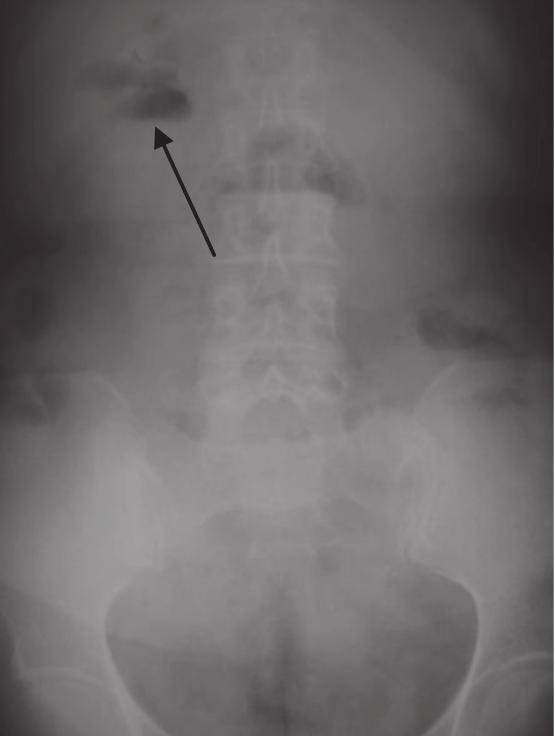 Marked small bowel dilatation with absence of colonic air is indicative of small bowel obstruction (SBO). Axial views of CT abdomen show cecal mass (arrow) causing distal SBO.