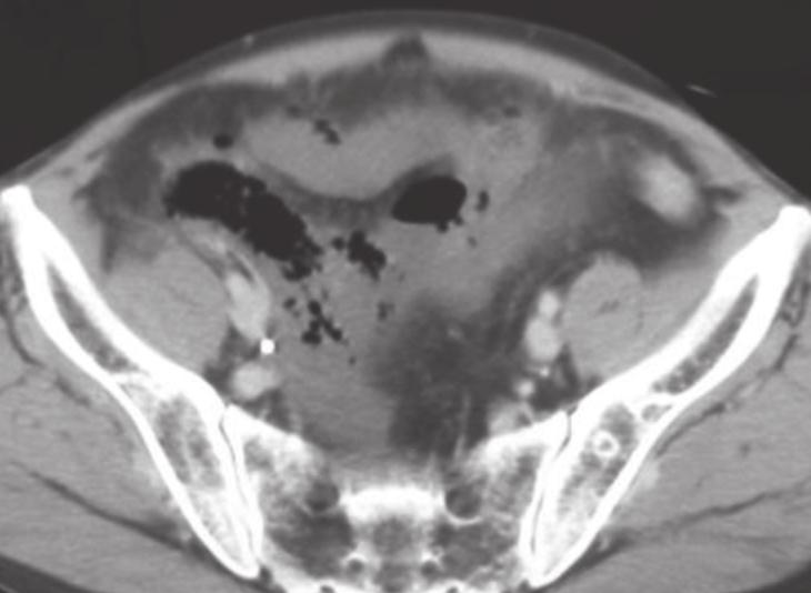 A 72-year-old man presented with abdominal pain, and fever. Supine plain radiograph shows abnormal collection of extraluminal bubbly air at the RLQ, best shown at the magnified view (arrows).
