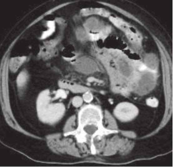 46 THAI J GASTROENTEROL 2015 Imaging of the Small Bowel Case 6. A 74-year-old man presented with abdominal pain and fever.