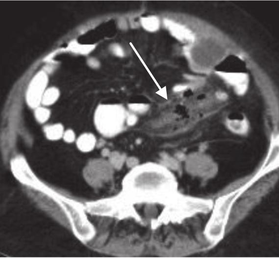 Jejunal diverticulosis is rare and usually asymptomatic(6).