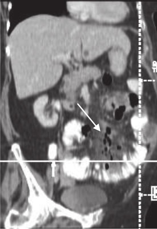 CT appearance of diverticulosis as outpouching lesions are similar to those found in colon. Therefore, imaging diagnosis is not difficult.