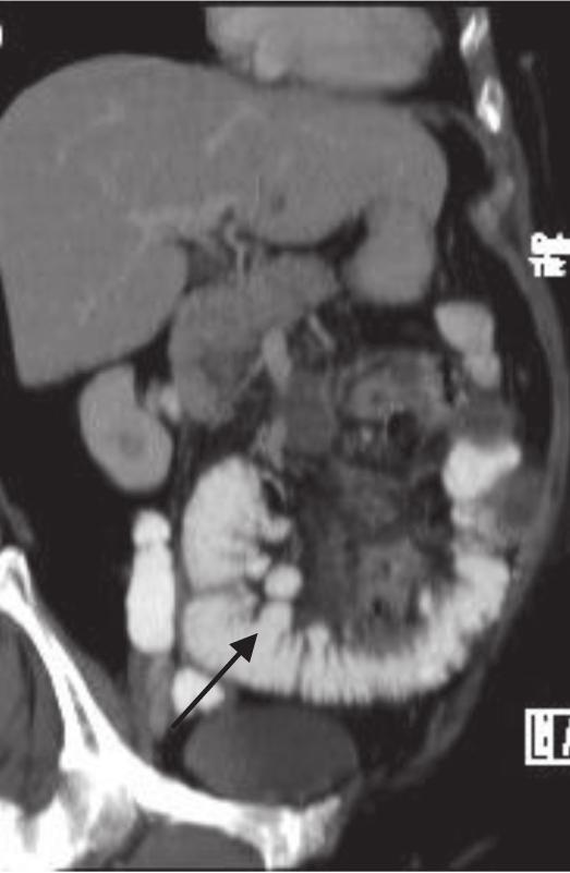 A 41-year-old woman presented with acute abdominal pain.