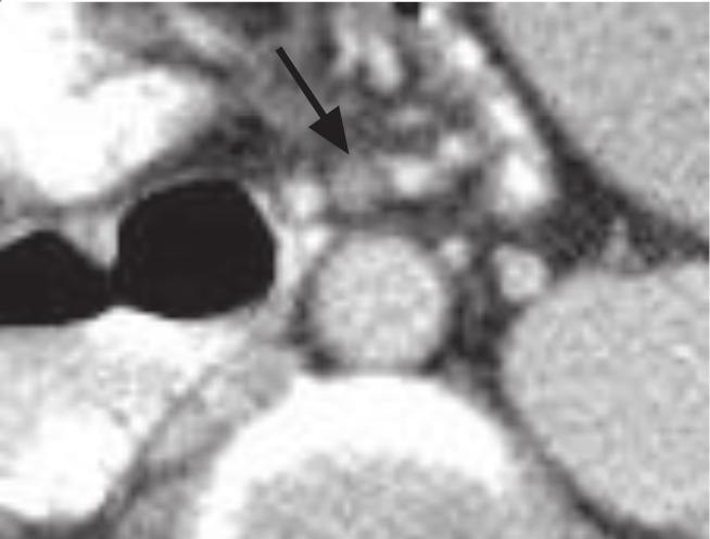 Combination of history and CT findings are consistent with mesenteric venous ischemia secondary to mesenteric hematoma.