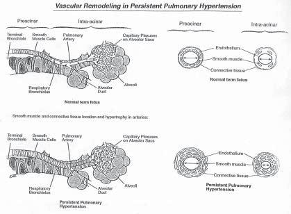 Fig. 22-5 Classification of persistent pulmonary hypertention of the newborn. (From Geggel R, Reid L: The structural basis of PPHN. Clin Perinatol 11:525-549, 1984; with permission.