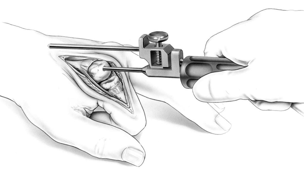 Trial implants (FIGURE 1B) are then inserted, and the joint is reduced.