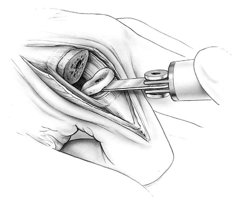 Step Four: Metacarpal Osteotomy Attach the proximal osteotomy guide on the alignment awl and reinsert the awl along the previously established medullary axis.