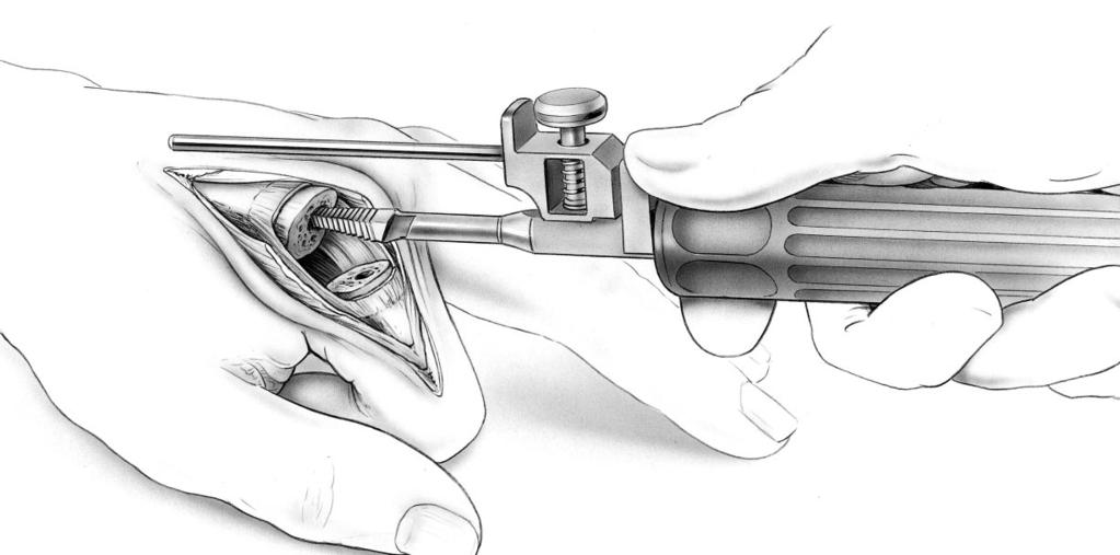 until the seating plane of the broach is flush to 1mm deeper than the osteotomy (FIGURE 18). During broaching, assess fit and movement resistance.