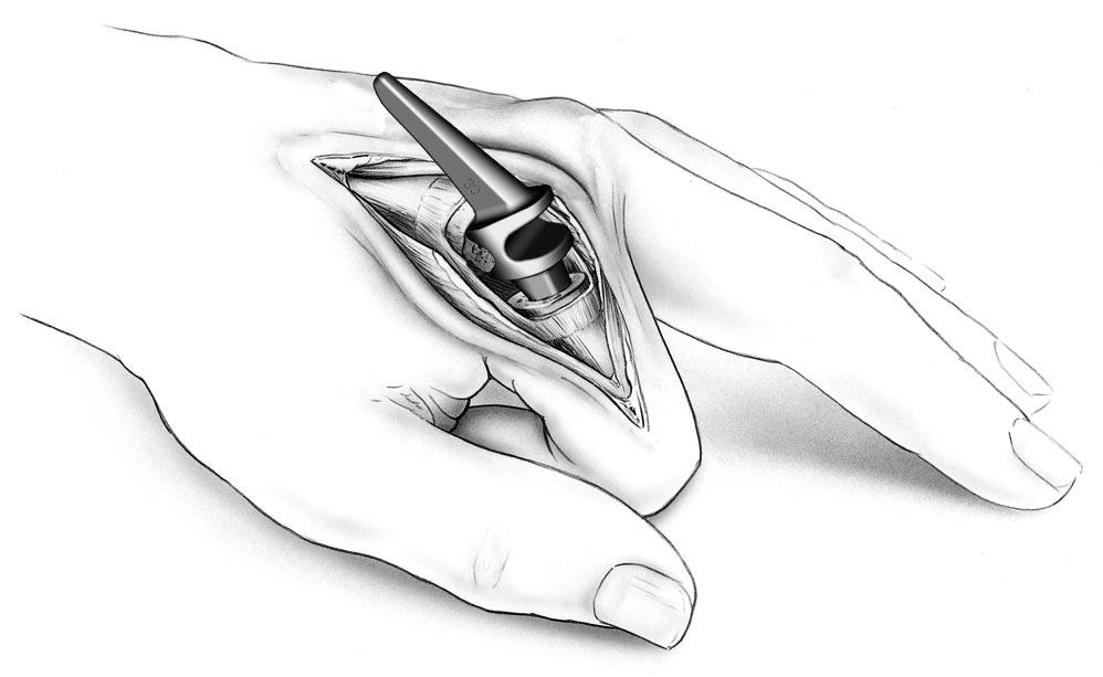 FIGURE 18: DISTAL BROACH ALIGNMENT The size of the phalangeal medullary canal is generally the limiting factor in implant size determination.