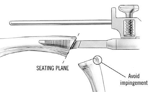 Continue broaching until the seating plane of the broach is 1mm deeper than the osteotomy (FIGURE 20).