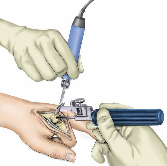 Step 3 Establishing Metacarpal Medullary Canal Alignment 3-1 Attach the Alignment Guide to the Alignment Awl. 3-1 Insert the Alignment Awl into the initial entry point.
