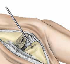 Step 5 Opening the Phalangeal Medullary Canal 5-1 Caution: Flex the joint to avoid damage, by impingement of the K-wire or Starter Awl, to the
