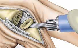 Step 7 Phalangeal Osteotomy 7-1 Remove Alignment Guide and place the Distal Cutting Guide on to the awl. The Cutting Guide provides a 5 distal back cut. Advance the Cutting Guide 0.5-1.