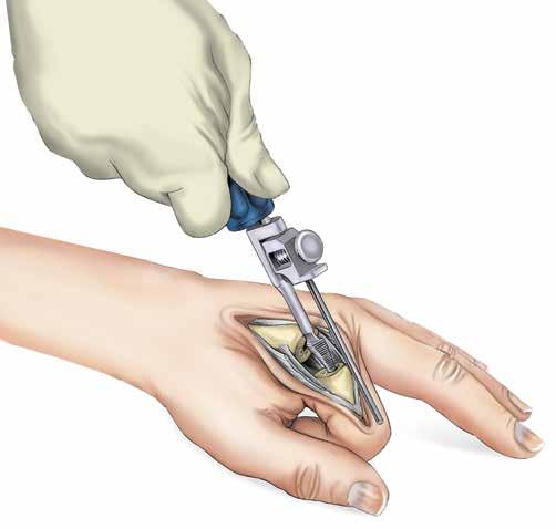 7-2 Step 8 Phalangeal Medullary Canal Broaching 8-1 After an entry way is made to allow insertion of the Size 10 Distal Broach, the canal is broached.