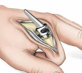 Step 8 Phalangeal Medullary Canal Broaching (continued) 8-3 Begin with the smallest size Distal Broach with the Alignment Guide attached and insert it halfway into the medullary canal.