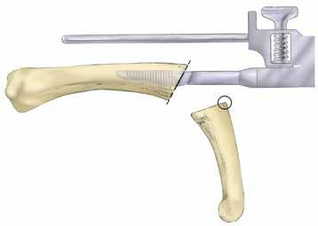 Re-insert the Broach and confirm position with X-ray.
