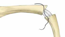 Collateral ligament stabilizing sutures may be useful at the MCP joint where there is joint laxity. It is recommended to use this suture for every patient with RA.
