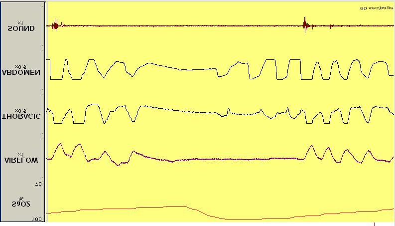 Mixed apnea: Complete cessation of airflow with gradual increase in