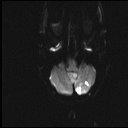 CASE STUDY Two areas of infarct were identified in the left cerebellum MRA of head and neck and chest x-ray returned normal results TTE showed normal LV size and function 20% Subsequent TEE confirmed