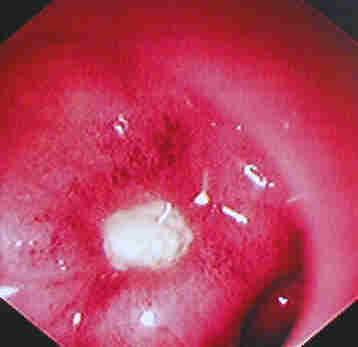 This patient with no Helicobacter infection got this ulcer