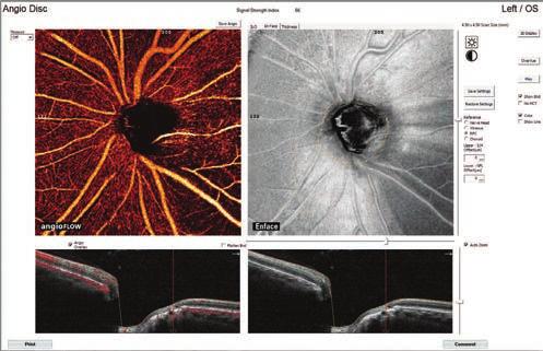 Optic Nerve Applications Visualize