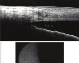 Anterior Segment Applications: Cornea Advance Visualize anterior segment structures to gain