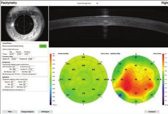 measurements may be entered into the ASCRS IOL calculator to generate a recommended lens power