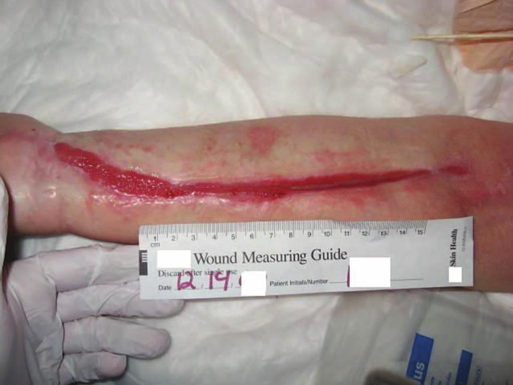 2 cm (Figure 10) representing a reduction of 93.2% in wound area and 99.7% diminution of wound volume since admission.