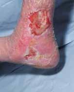 A number of factors can influence the production of exudate, including the underlying pathophysiology, location of the wound, size of the wound, bacterial load and the presence of oedema.