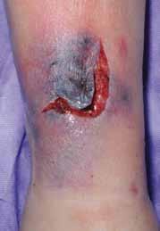 of trauma (commonly, shear and friction) and are usually found to occur on the extremities (Carville et al, 2007).