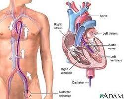 attack because it is associated with extensive damage to the heart.
