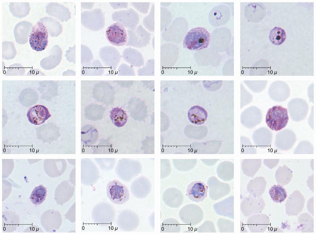 a b c d e f g h i j k l Gametocytes Figure 4 of P. knowlesi parasites in human infections Gametocytes of P. knowlesi parasites in human infections. Giemsa-stained thin blood films from patients KH370-a,h; KH369-b,c,j,k; KH364-d,e,f,g; KH431-i,l.