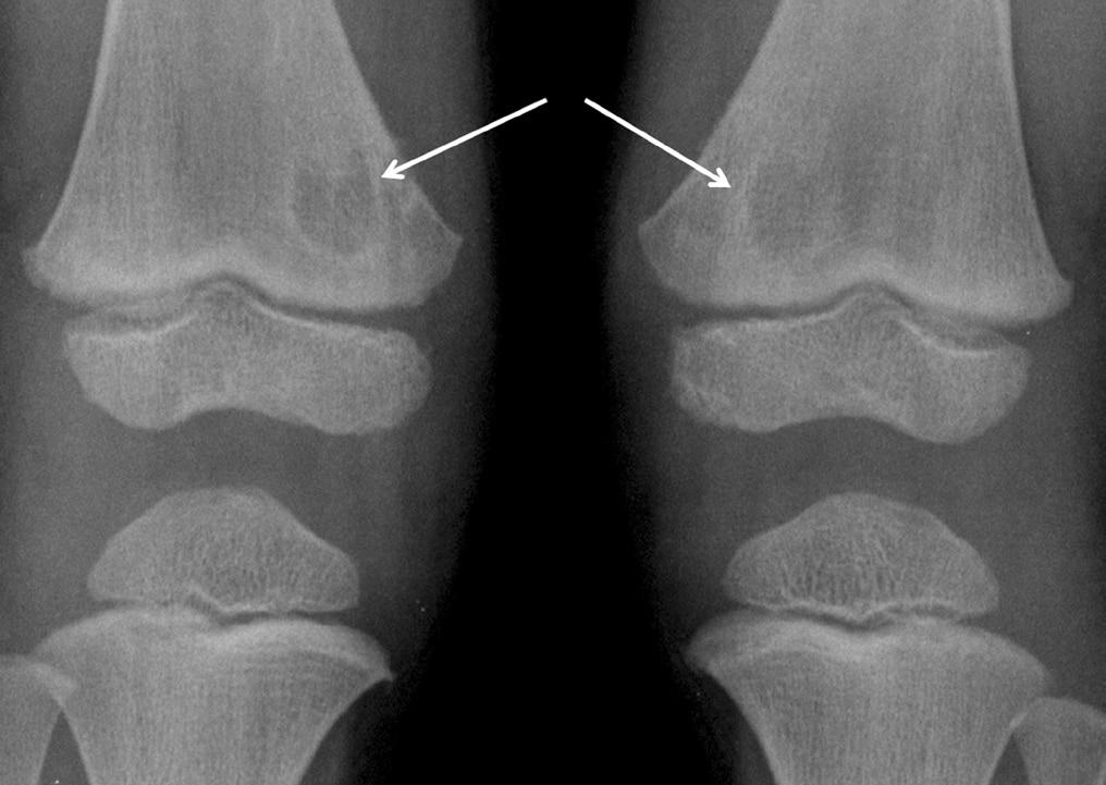 307 Fig. 1. Metaphyseal lucent area. (A) The non-ossifying fibroma is an enlarged benign cortical defect occurring in long bone of the lower extremity.