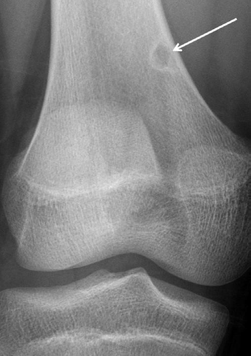 Osteochondroma is a benign tumor characterized by an overgrowth of cartilage and bone near the end of the bone and near the growth plate.