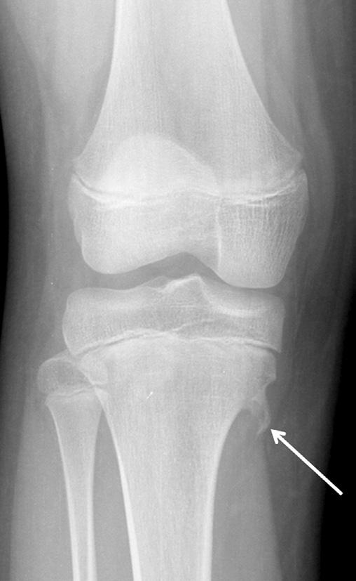 An osteochondroma was defined as an overgrowth of cartilage and bone near the end of the bone in close proximity to the growth plate (Fig. 3).