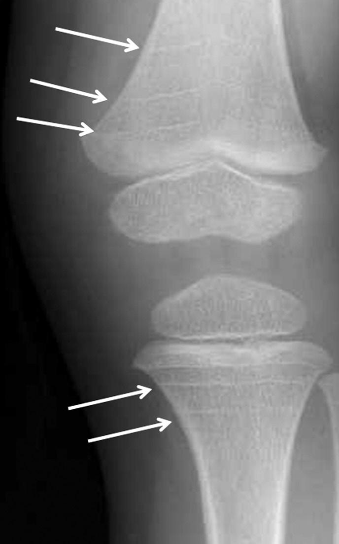 308 graphic findings. Prior sample size estimation by precision analysis indicated an assessment of 36 knee radiographs as a minimum.