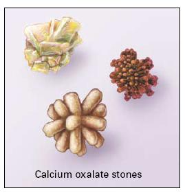 goals Review epidemiology of stones and hypercalciuria Discuss risk factors for kidney stones Provide framework