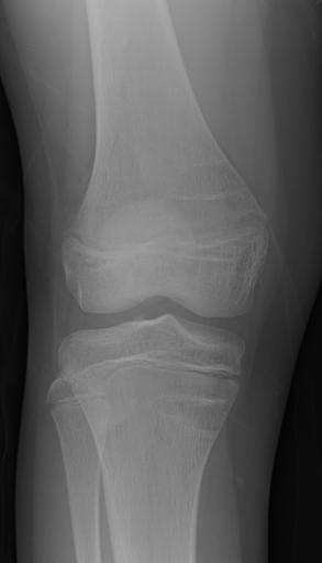 Radiographic Appearance of Rickets at Baseline and Follow-up Knee radiographs in ~11-year-old girl with XLH during therapy
