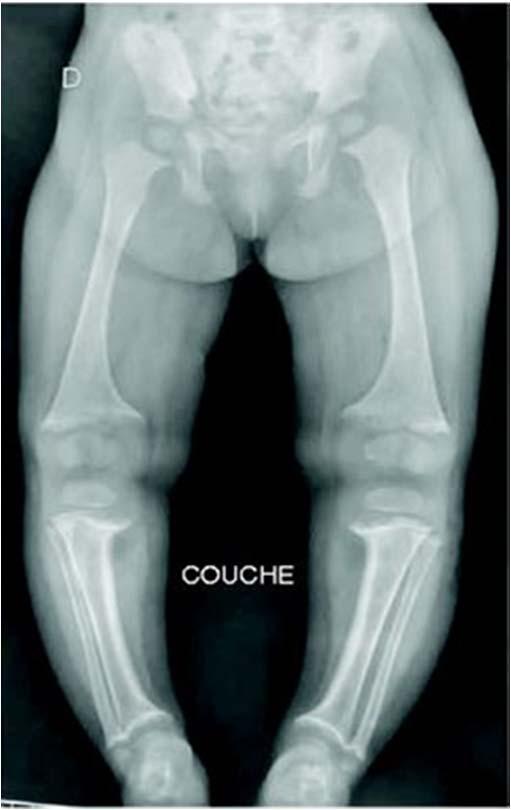 Children with XLH May Have Rickets, Skeletal Deformity, and Impaired Growth Rickets/Osteomalacia Bowing of the Leg Impairment of Linear Growth 190 170 150 Females 95% 75%