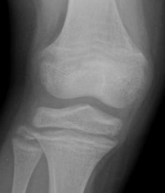 knee, and leg during treatment X-rays read by 3 independent experts blinded to dose -3-2 -1 0 +1 +2 +3 Severe Worsening Moderate