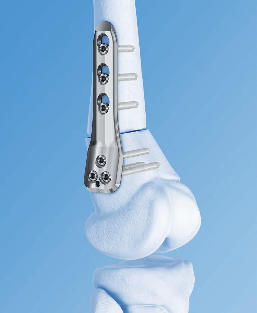 LCP Pediatric Condylar Plate 90, 3.5 and 5.0. For distal femur osteotomies.
