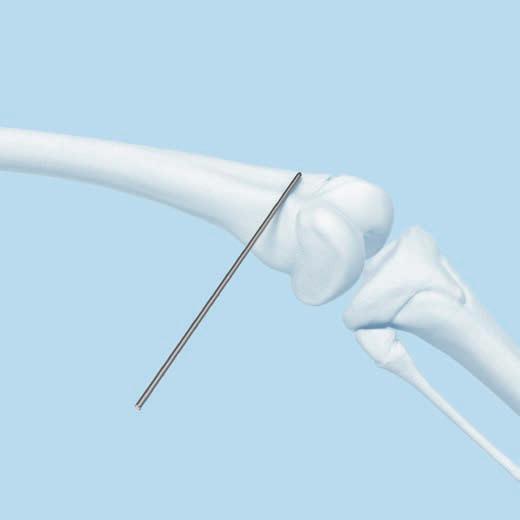 Guide Wire Insertion 1 Localize the frontal plane of the distal femur Instrument 292.200 Kirschner Wire B 2.