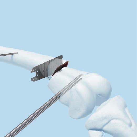 Osteotomy The first cut of the osteotomy should be parallel to the Kirschner wires and sufficiently proximal to allow the third screw in hole C to gain adequate purchase (3).