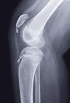 Preoperative, lateral Fracture of the inferior pole