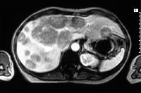 hour urine 5HIAA Serum Chromogranin A PET (Europe) Diagnosis: CT/MRI Nuclear Peptide Scans Both MIBG and somatostatin