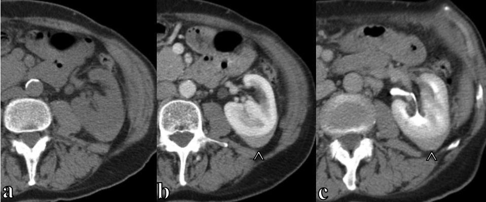 Figure 2: This is the follow-up CT scan of a 77 year-old male with primary renal lymphoma, acquired three months after he initially presented to the family practice clinic with gross hematuria.