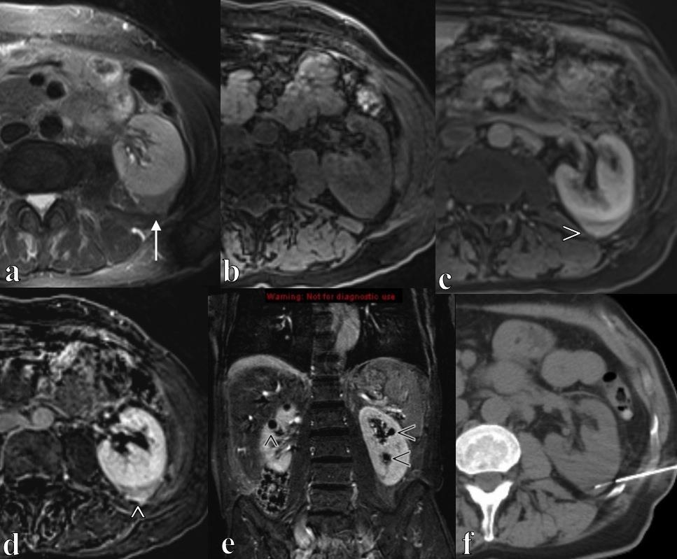 Figure 3: This is a 77 year-old male who was diagnosed with primary renal lymphoma following this MRI and CT-guided biopsy.