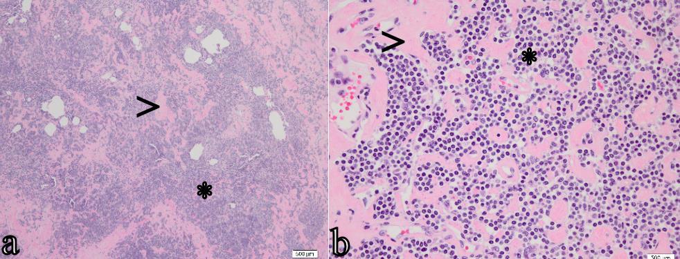 Figure 4: These are pathology images from a hematoxylin and eosin staining of a subcapsular renal mass in a 77 year-old male diagnosed with primary renal lymphoma.